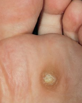 heloma