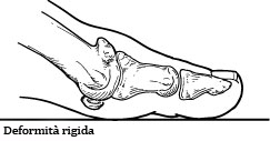 Alluce rigido